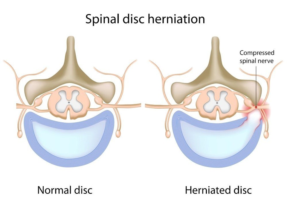 illustration of a herniated disc