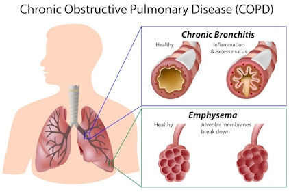 Illustration highlighting the effects of chronic obstructive pulmonary disease