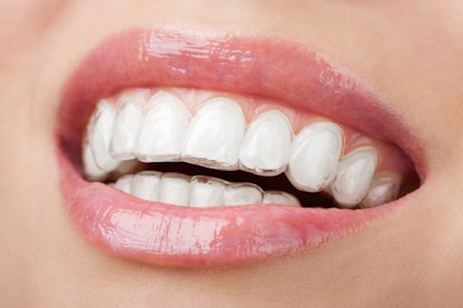 A patient wearing an Invisalign® tray