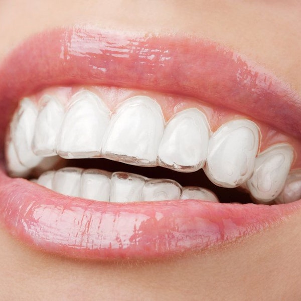Close up of person wearing Invisalign