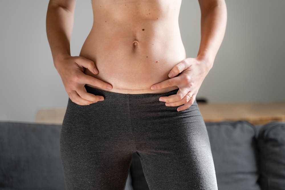 Woman with hysterectomy scar on abdomen