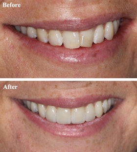 Crooked smile before Invisalign