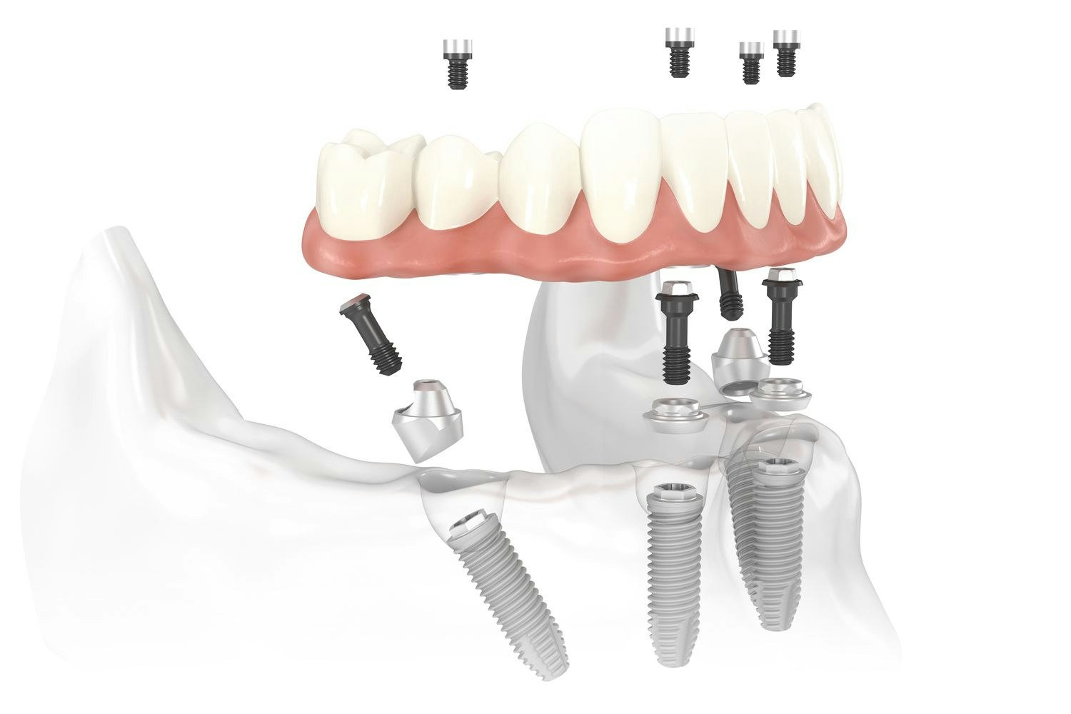 Diagram of how All-on-4 implants anchor a denture to the jawbone