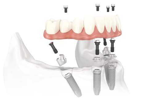 Illustration of implant-supported dentures.