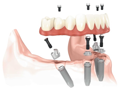 All-on-4 dental implants