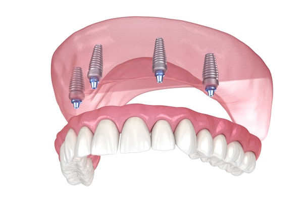 Implant-supported dentures