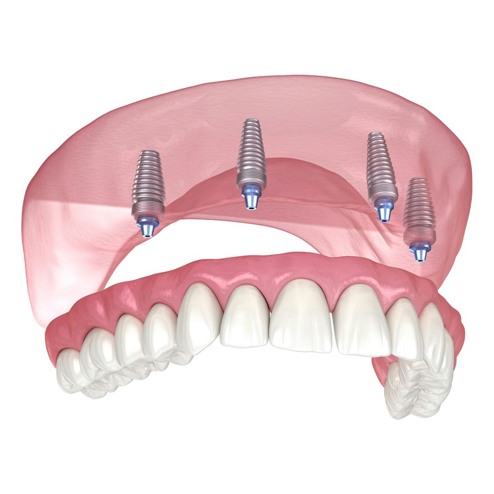 All-on-4 denture