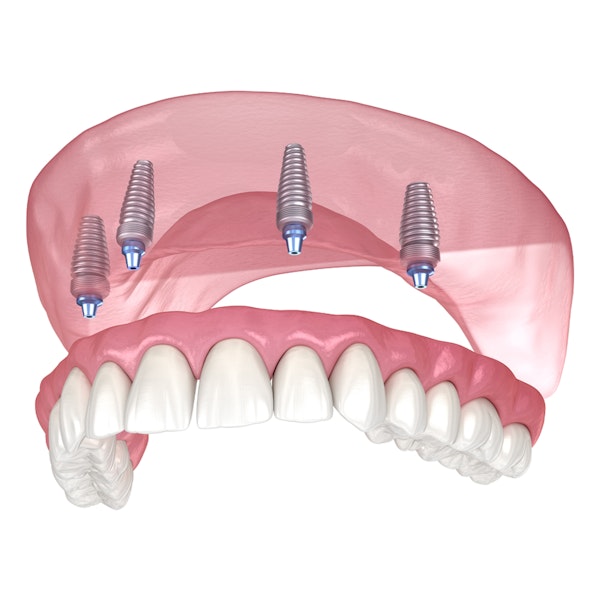 All-on-4 dental implants