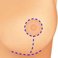 Anchor Incision