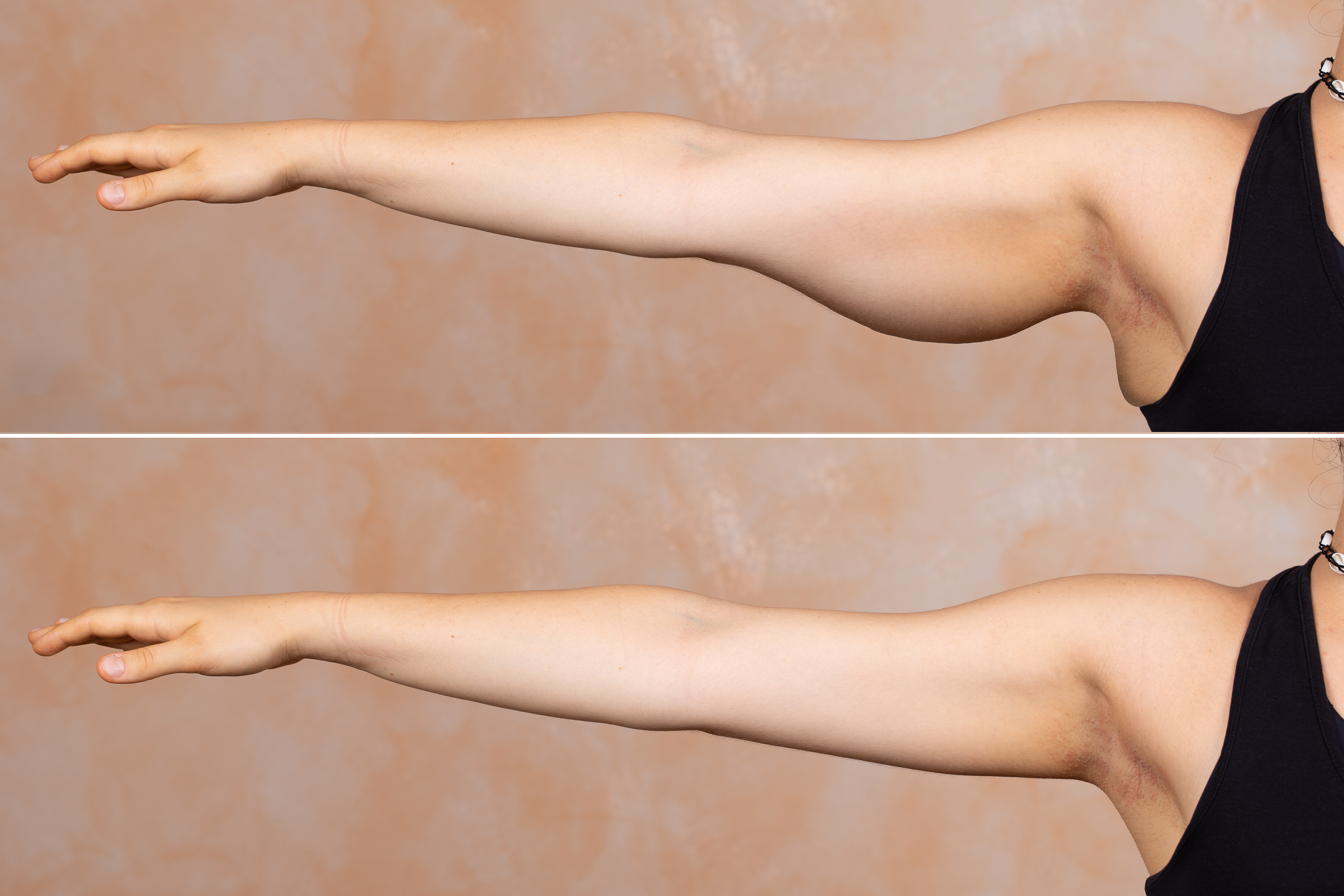 Permanent Arm Fat Removal  Arm Liposuction With AirSculpt®