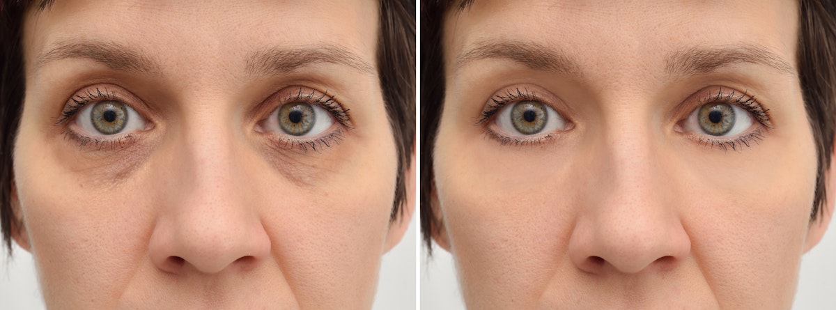 After a Blepharoplasty