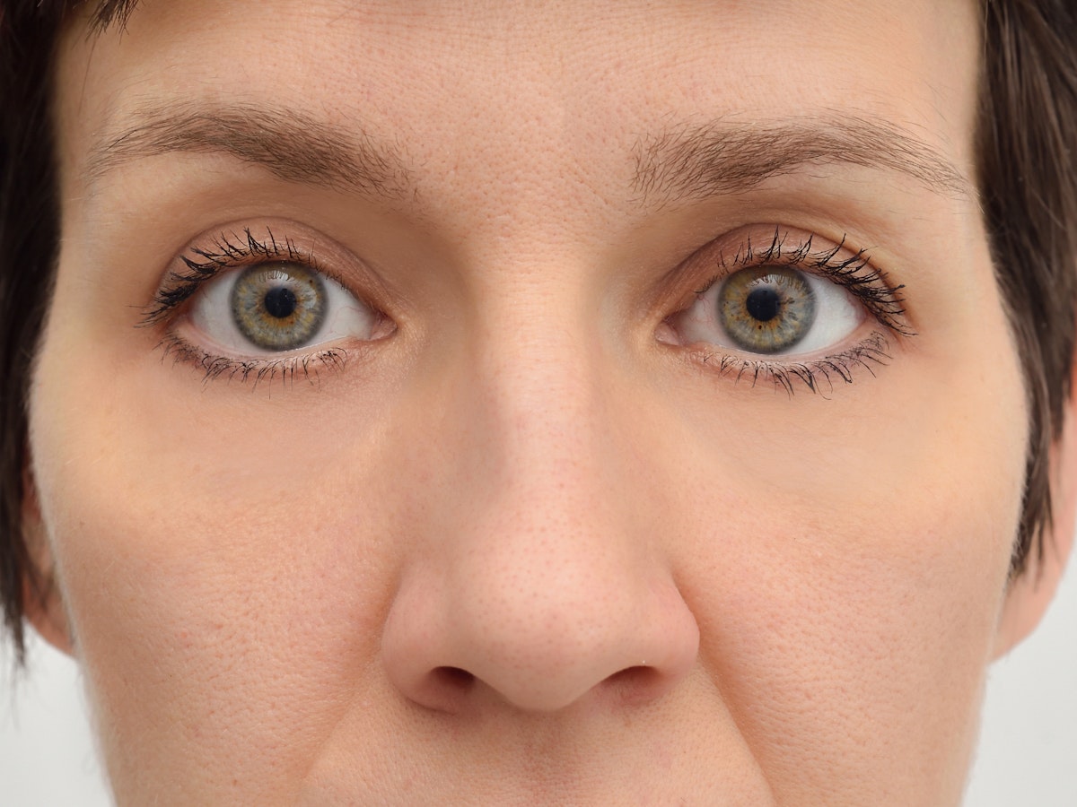 After a Blepharoplasty