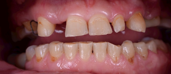 short yellow, uneven teeth