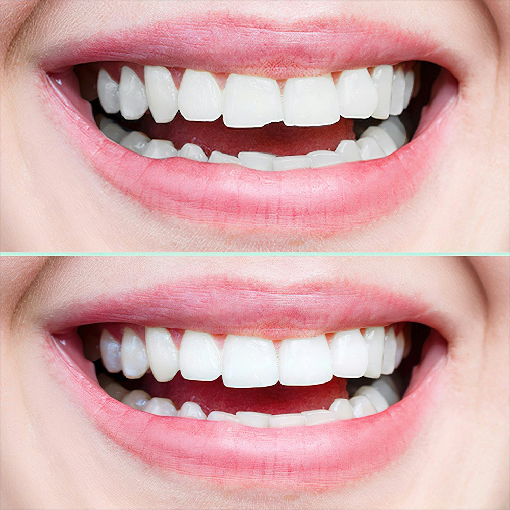 Dental Bonding Before and After