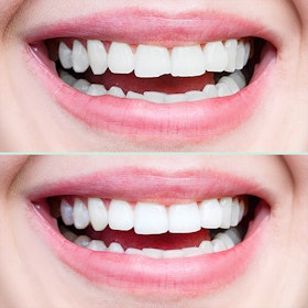 Dental Bonding Before and After
