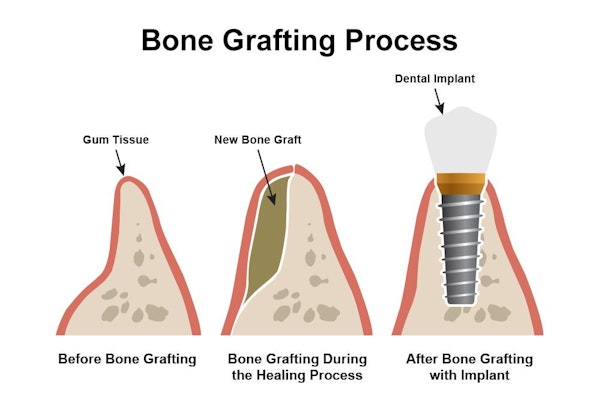 Bone grafting process