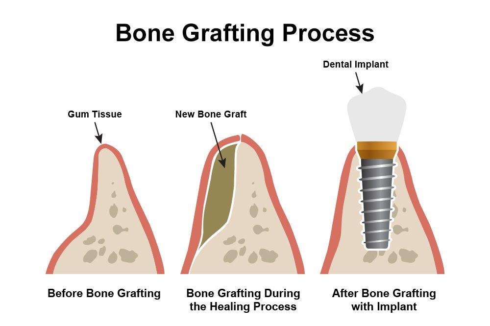 An illustration of the bone grafting procedure
