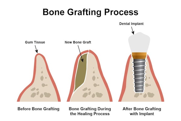 Bone grafting process