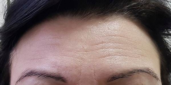Before BOTOX procedure