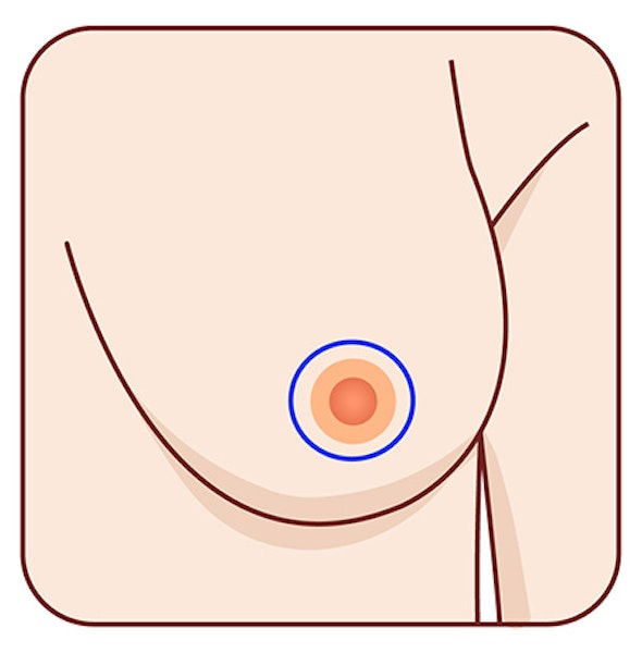 Circular incision