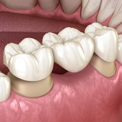 Dental bridge