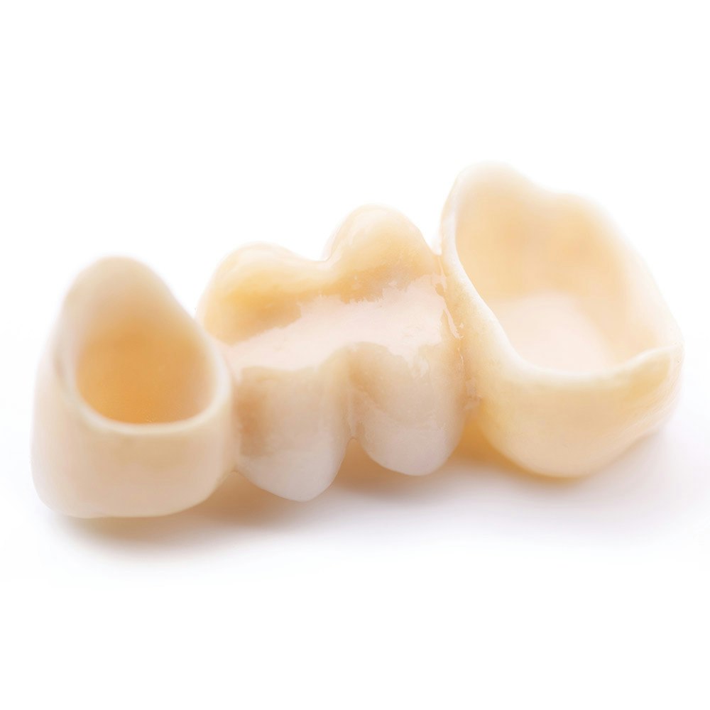 Dental Bridge