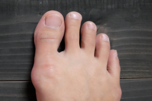 Bunion Affecting the Big Toe