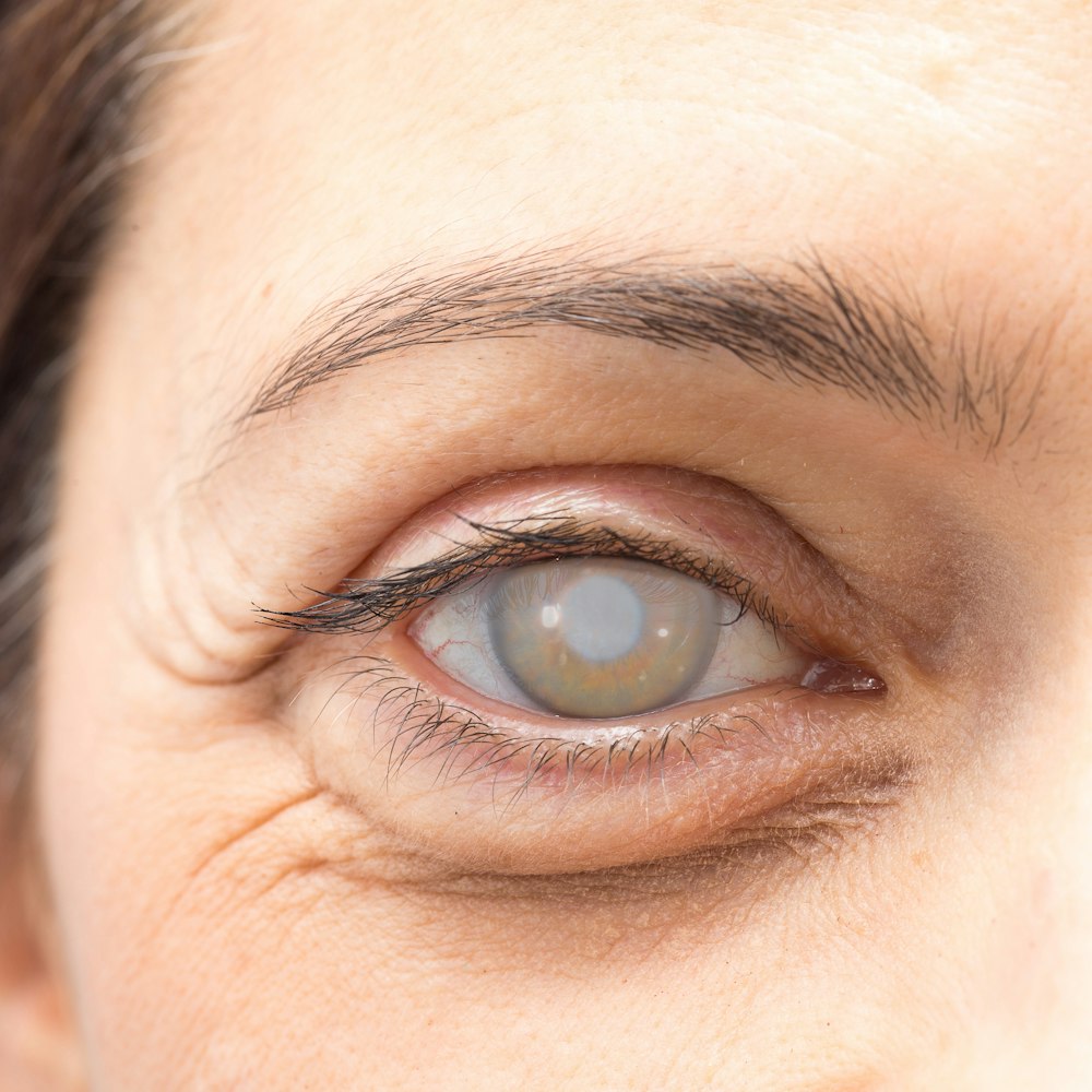 Patient with Cataracts