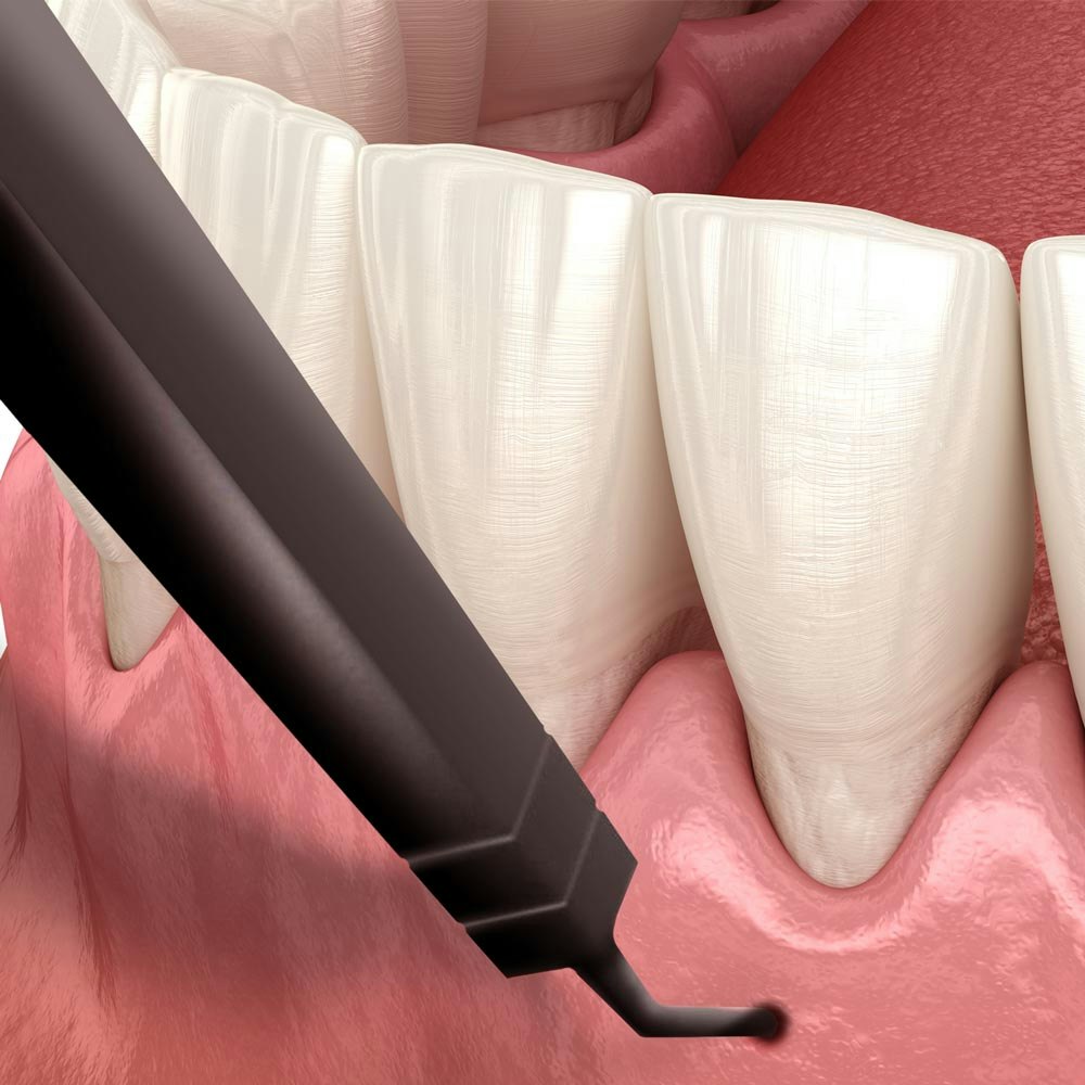 Pinhole Gum Rejuvenation illustration