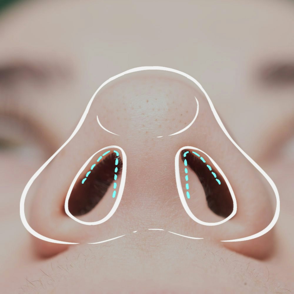 picture of nose with closed rhinoplasty diagram over top