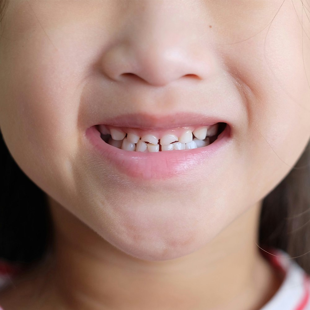 Young girl's chipped teeth