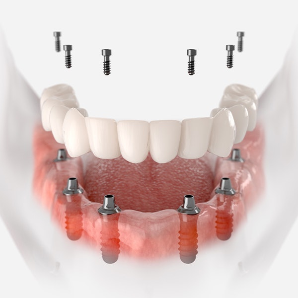 Implant-supported Denture