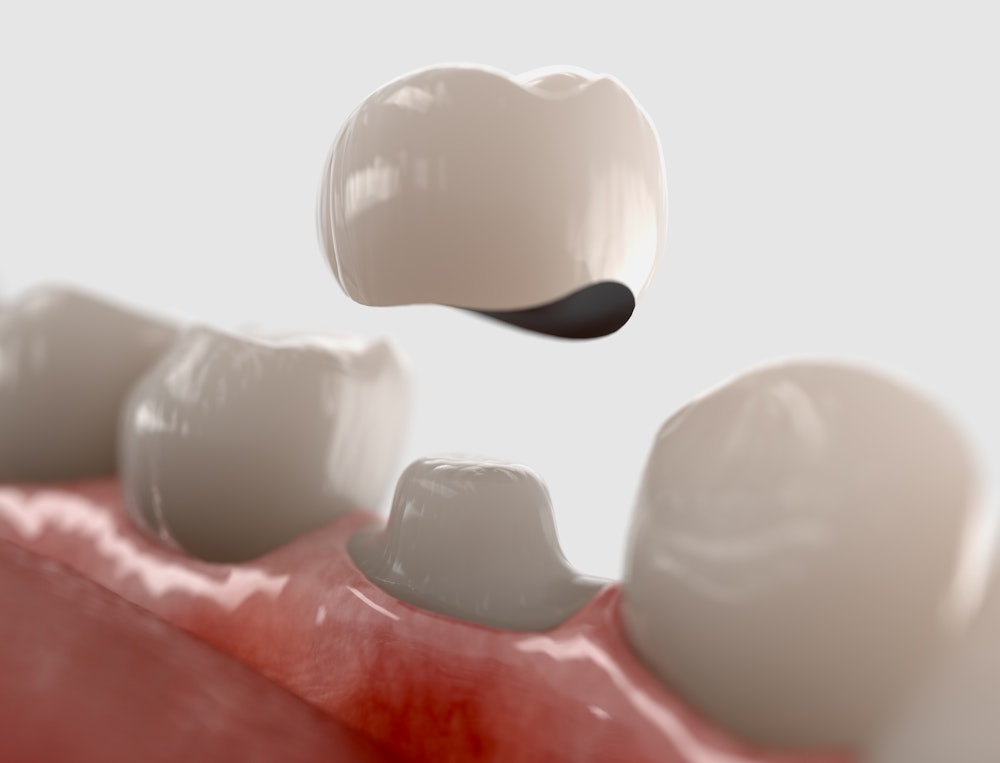 Illustration of a same-day dental crown.