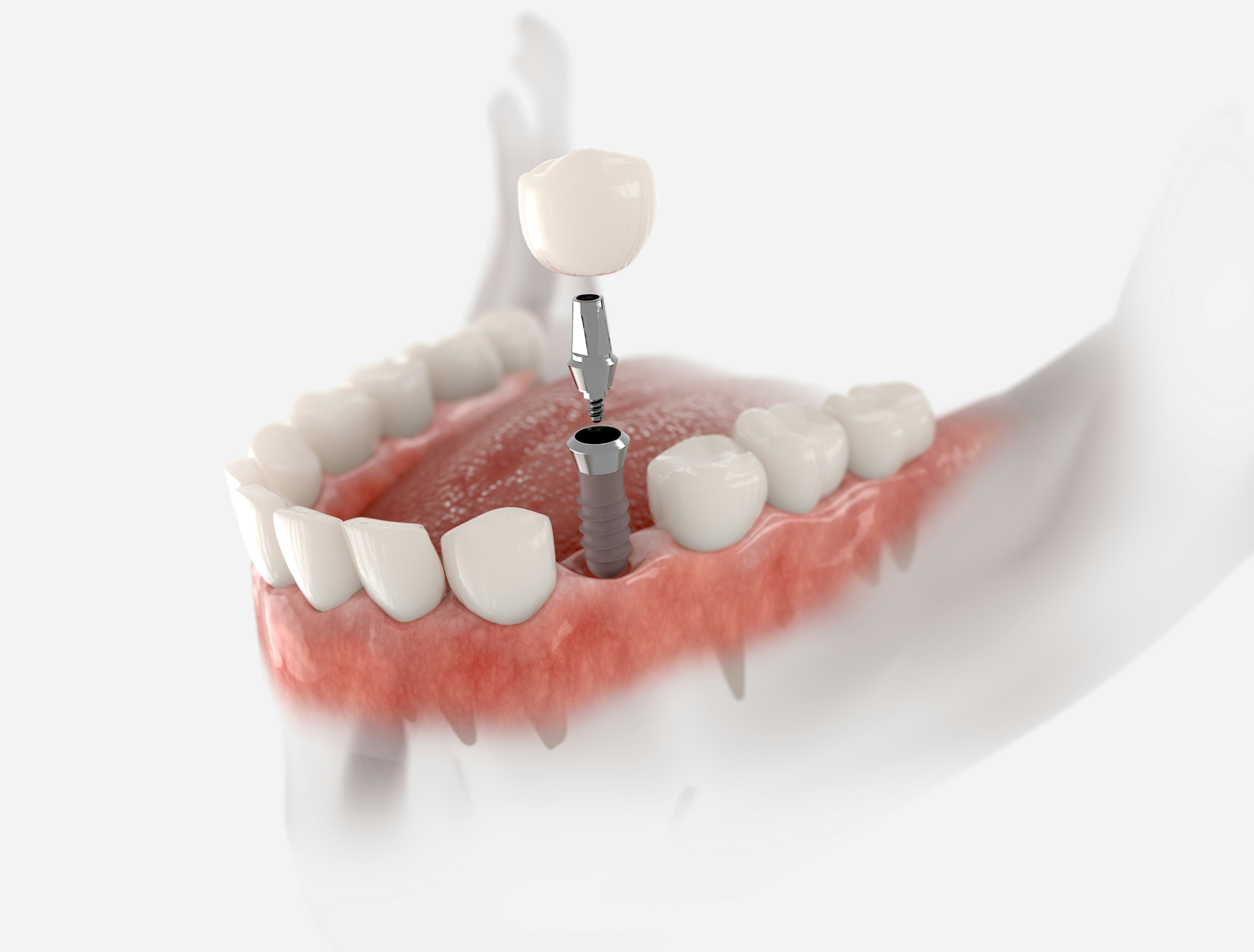 Dental implant