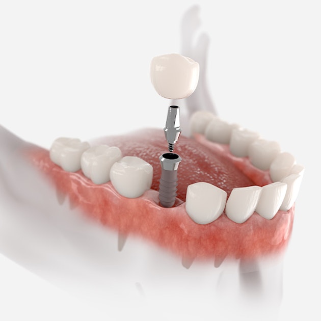 a #D diagram of a dental implant