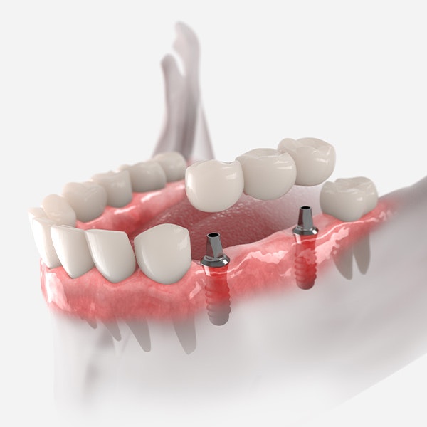 Implant-Supported Bridge