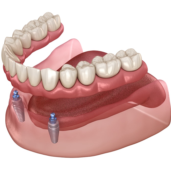 implant dentures