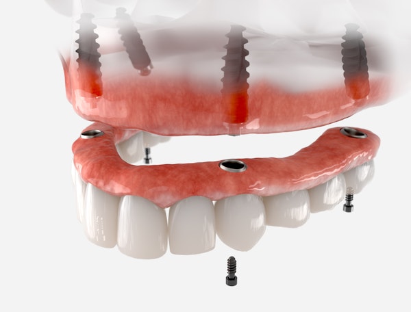 denture implant missing arch