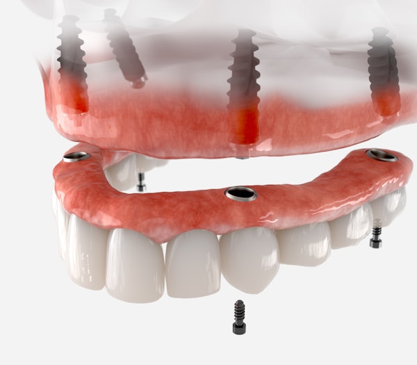 denture implant missing arch