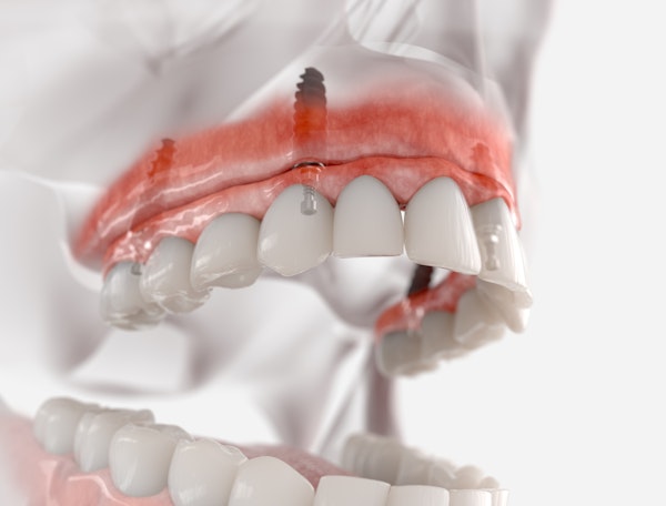 Implant-supported denture