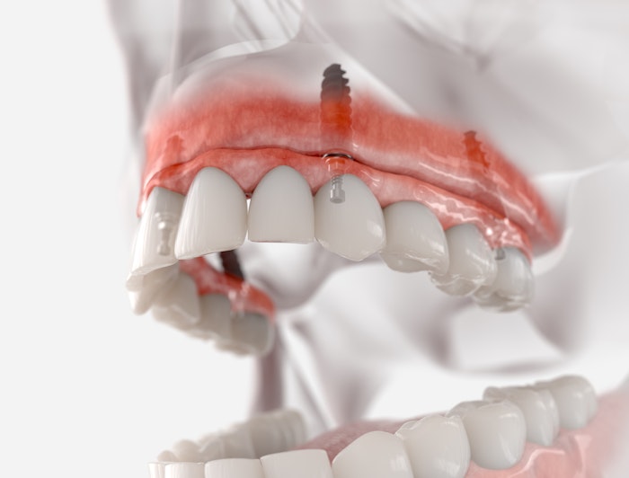 Illustration of All-on-4 denture