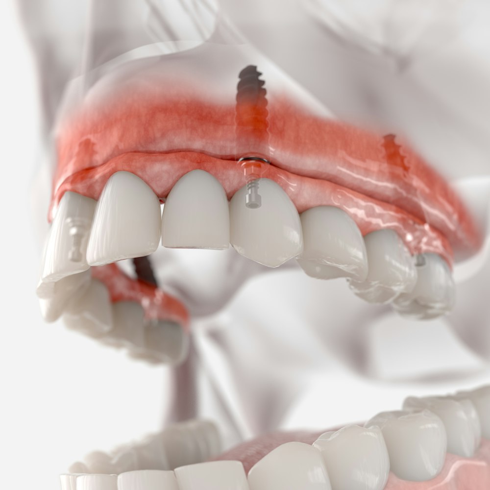 Dentures
