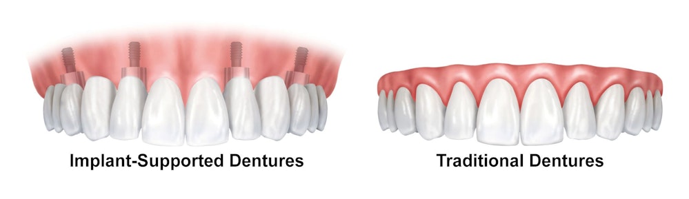 image of dental implants vs. implant supported restorations