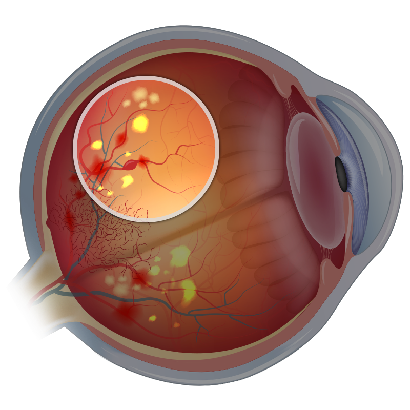 Leaking Blood Vessels