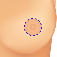 Donut Incision