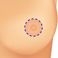 Donut Incision