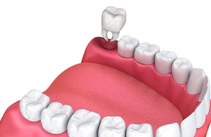 a tooth being extracted