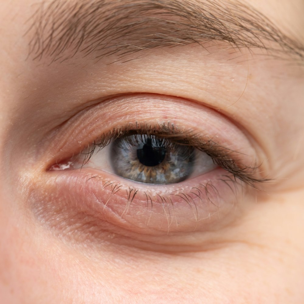 Bags Beneath the Lower Eyelids