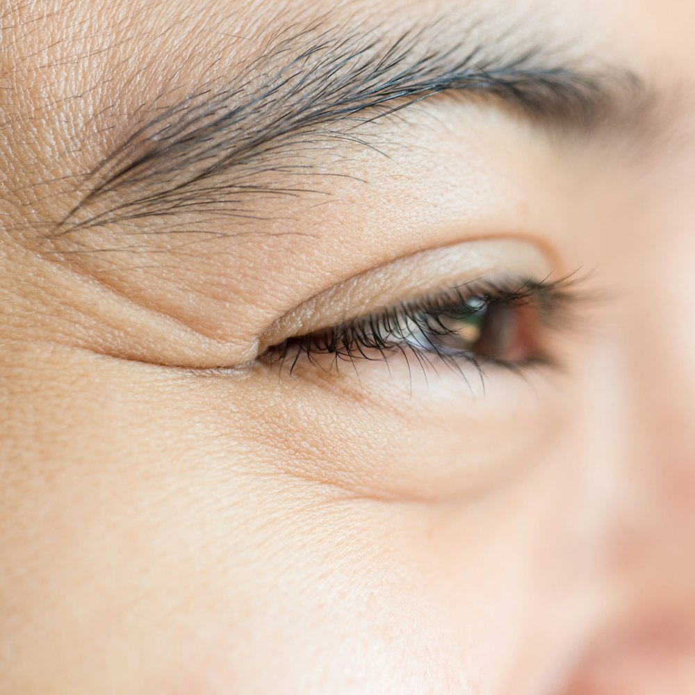 Wrinkles on the Upper Eyelids