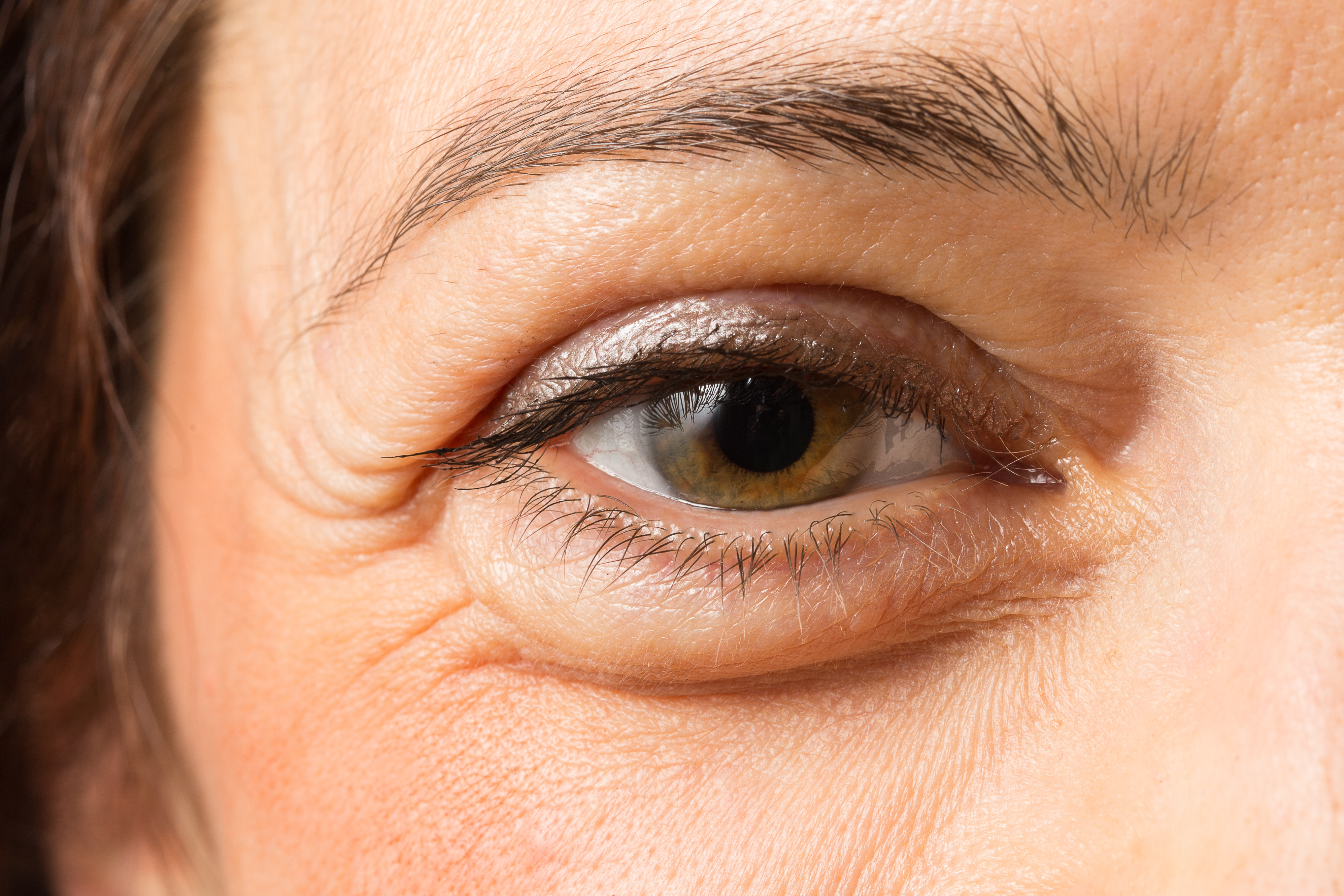 Fatty deposits on lower eyelid
